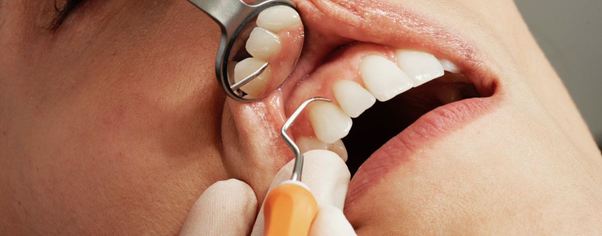 Periodontologia - sprawdzenie stanu jamy ustnej